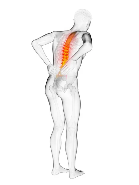 Mann Mit Akuten Rückenschmerzen Illustration — Stockfoto