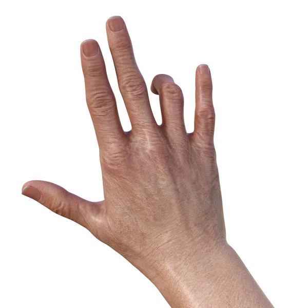 Illustration Displaying Hand Female Patient Dupuytren Contracture Condition Causes Fingers — Stock Photo, Image