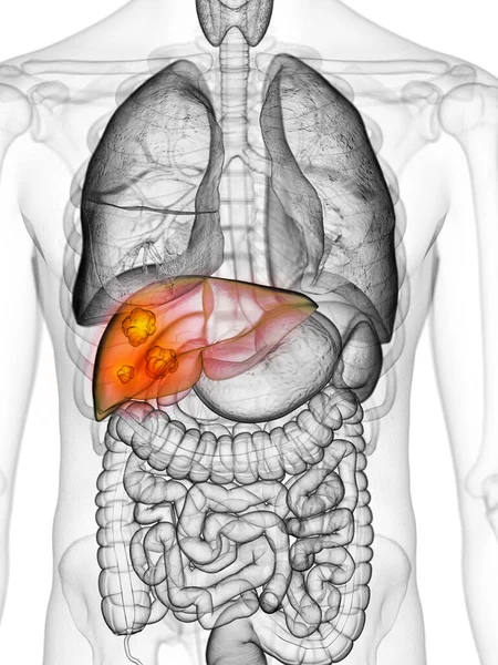 肝がん 白い背景のイラスト — ストック写真