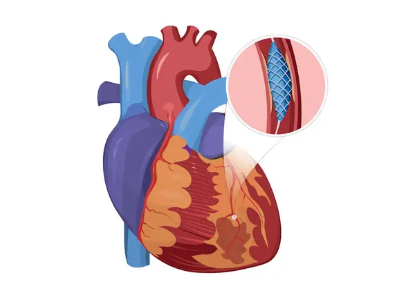 Иллюстрация Человеческого Сердца Обработанного Стентом Процедура Известна Коронарная Ангиопластика Стенты — стоковое фото