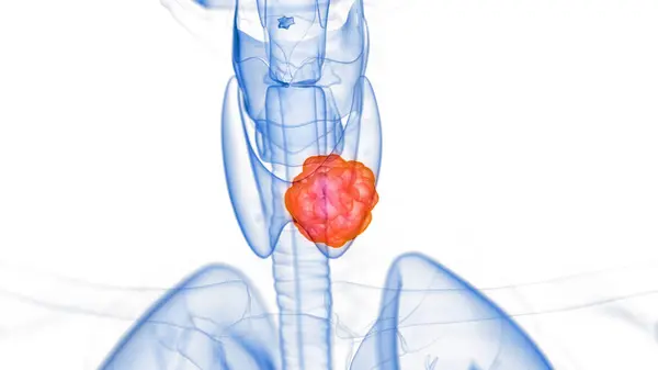 Tumore Della Tiroide Illustrazione Sfondo — Foto Stock