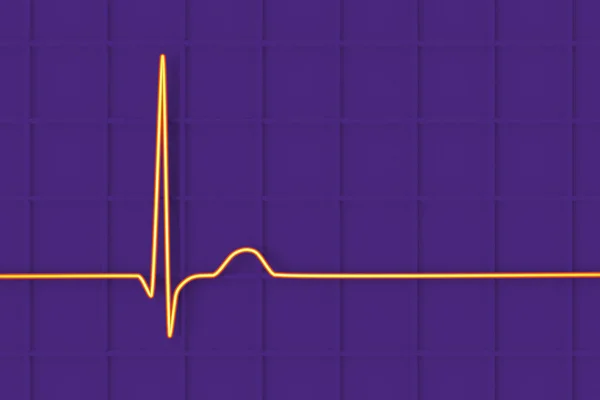 Illustration Electrocardiogram Ecg Displaying Junctional Rhythm Heartbeat — Stock Photo, Image