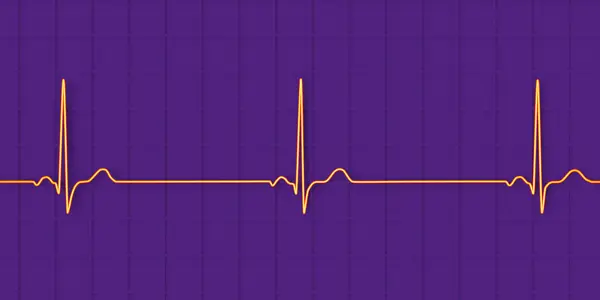 Illustration Electrocardiogram Ecg Showing Sinus Bradycardia Condition Characterised Slow Heart — Stock Photo, Image