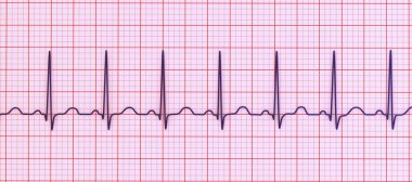 Elektrokardiyogramın (ECG) sinüs taşikardisi göstermesi, kalp ritminin normalin üst sınırından daha yüksek olmasıyla karakterize edilir (yetişkinlerde 90-100 bpm).).