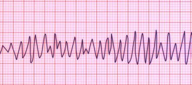 Torsades 'in ritmini gösteren elektrokardiyogramın (EKG) çizimi. Bu tehlikeli bir kalp ritmi. Hızlı ve düzensiz atımlarla karakterize edilir. Elektrik ekseni etrafında dönerek bayılmaya ya da kalp krizine neden olabilir..
