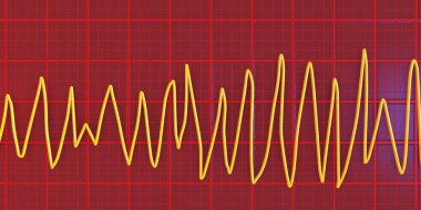 Torsades 'in ritmini gösteren elektrokardiyogramın (EKG) çizimi. Bu tehlikeli bir kalp ritmi. Hızlı ve düzensiz atımlarla karakterize edilir. Elektrik ekseni etrafında dönerek bayılmaya ya da kalp krizine neden olabilir..