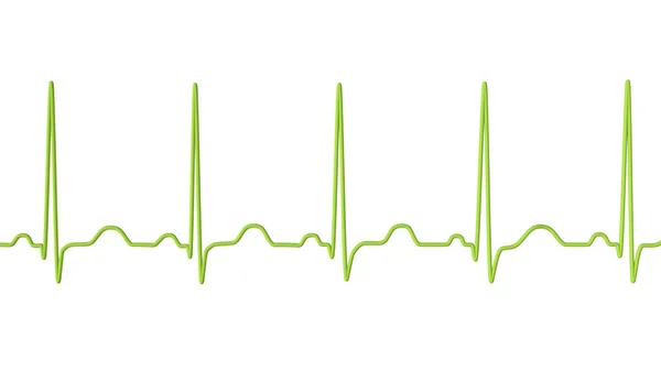 Ilustração Eletrocardiograma Ecg Mostrando Taquicardia Sinusal Ritmo Cardíaco Comum Caracterizado — Fotografia de Stock