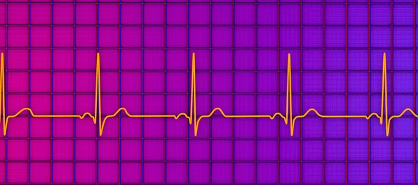 Illustration Eines Elektrokardiogramms Ekgs Das Einen Normalen Herzrhythmus Bei Einer — Stockfoto