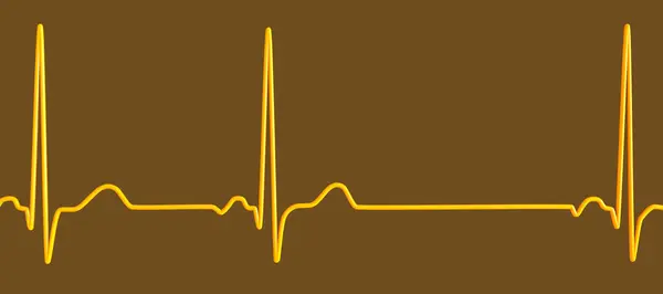 Illustration Electrocardiogram Ecg Displaying Sinus Arrhythmia Condition Characterised Irregular Heart — Stock Photo, Image