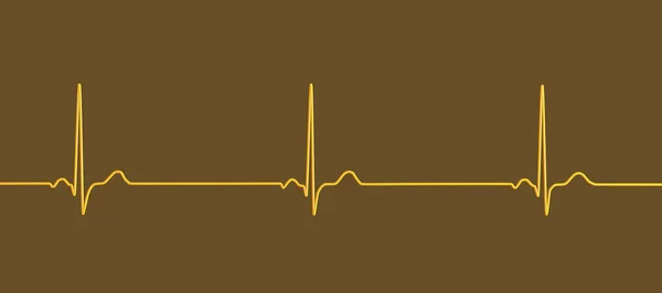 Illustration Eines Elektrokardiogramms Ekgs Mit Sinus Bradykardie Dieser Zustand Ist — Stockfoto