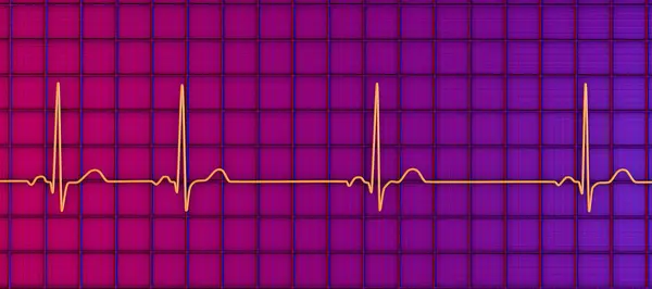 Illustratie Van Een Elektrocardiogram Ecg Met Sinusaritmie Een Aandoening Die — Stockfoto