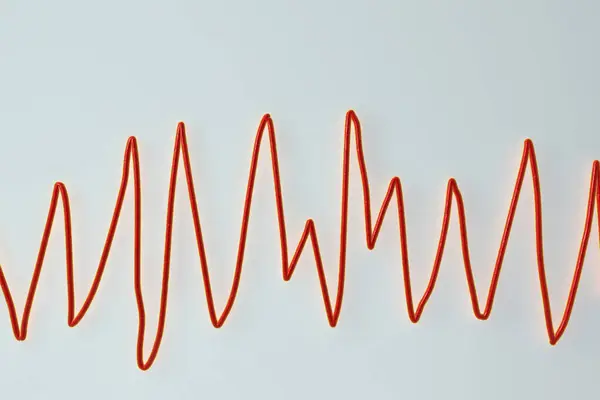 Illustrazione Elettrocardiogramma Ecg Che Mostra Ritmo Torsioni Punta — Foto Stock