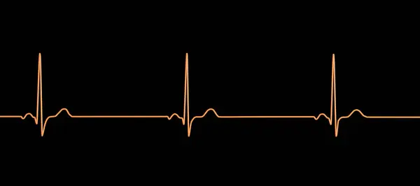 Illustration Electrocardiogram Ecg Showing Sinus Bradycardia Condition Characterised Slow Heart — Stock Photo, Image
