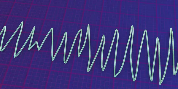 Illustration Electrocardiogram Ecg Showing Torsades Pointes Rhythm — Stock Photo, Image