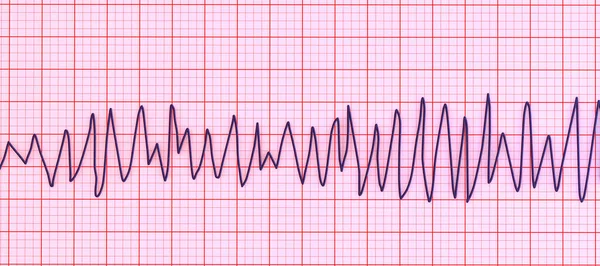 Ilustração Eletrocardiograma Ecg Mostrando Ritmo Torsades Pointes Este Ritmo Cardíaco — Fotografia de Stock