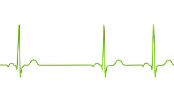 Ilustração Eletrocardiograma Ecg Mostrando Arritmia Sinusal Uma Condição Caracterizada Por — Fotografia de Stock