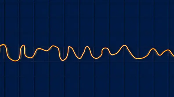 心电图 Ecg 显示心室颤动的混沌节律 一种威胁生命的心律失常 — 图库照片