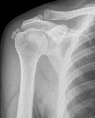 Kistik tendiniti olan bir hastanın omuz röntgeni. Kalsiyum tendonu tendonun içinde kalsiyum birikintisi olduğunda kalsiyum tendonu oluşur, genellikle döner manşet tendonu..