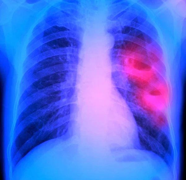一名50岁病人因肺部脓肿而左肺 有两个空洞 粉红色 的彩色胸部X光检查 脓肿是组织内腔内的积液 — 图库照片