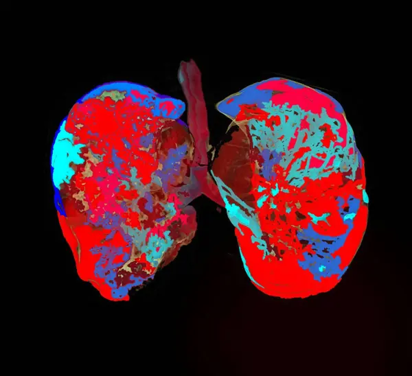 健康肺 彩色计算机断层扫描 — 图库照片