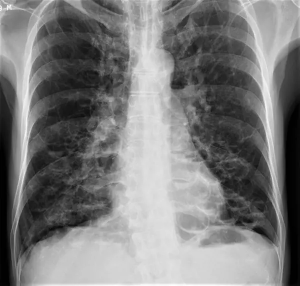 Bronşittazisi olan bir hastanın göğüs röntgeni. Bronşittazi bronşiyollerin kalıcı genişlemesi ve bozulmasıdır (akciğer solunum yolları).).