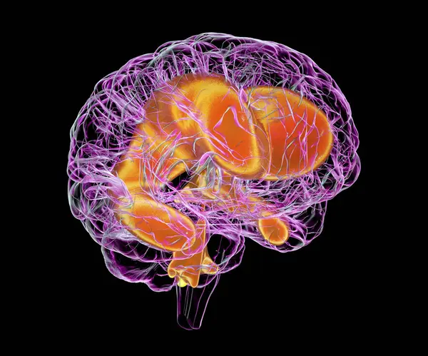 子どもの脳の拡大した心室 ヒドロスファルス を描いたコンピュータイラスト — ストック写真