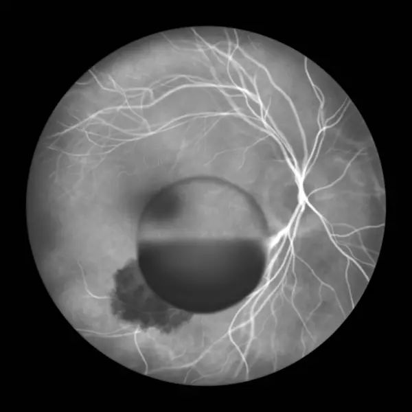 Illustration Depicting Terson Syndrome Revealing Intraocular Haemorrhage Observed Fluorescein Angiography — Stock Photo, Image