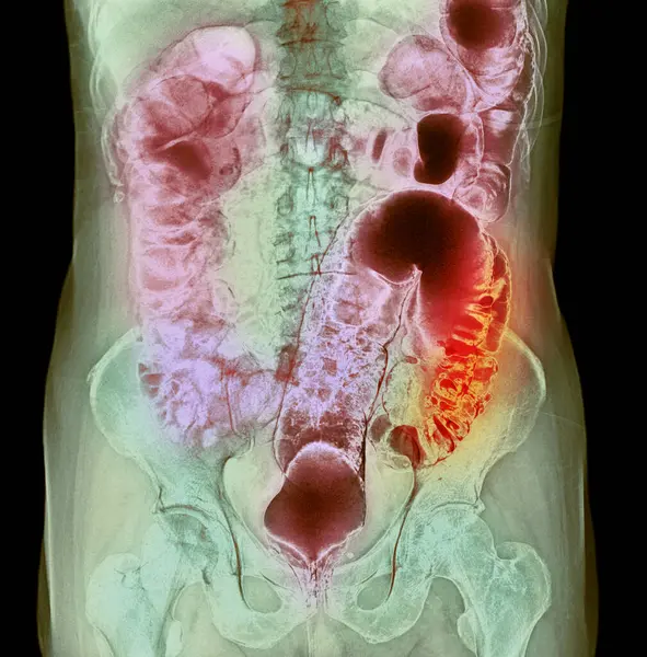 彩色钡灌肠对比X光显示结肠癌 食管网是可以在消化道内壁形成的小鼓包 通常在大肠或结肠的下部形成 — 图库照片
