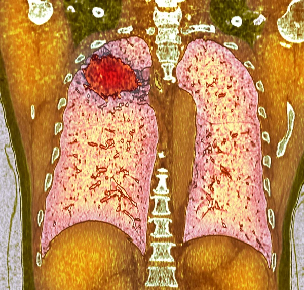 肺癌患者肺的彩色冠状Ct扫描 显示右肺有一个不规则边界的实性肿块 — 图库照片