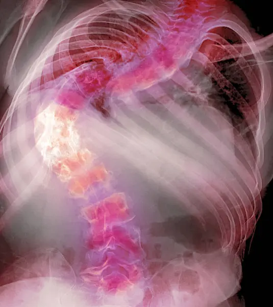Radiografia Colorida Coluna Vertebral Paciente Com Dor Nas Costas Mostrando — Fotografia de Stock