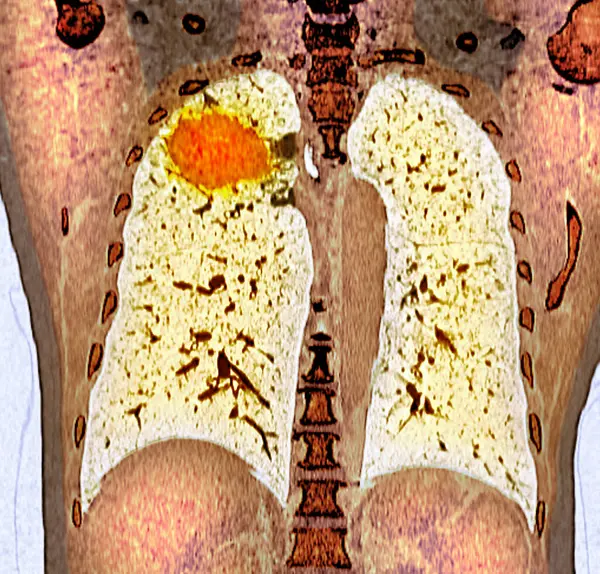 Farbige Koronale Brust Computertomographie Der Lungen Eines Patienten Mit Lungenkrebs — Stockfoto