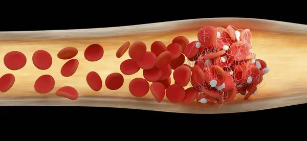 用红血球 红血球 卡在纤维蛋白网中形成血凝块的血管的说明 纤维蛋白的产生是由血小板引起的 当血管受损时 血小板会被激活 — 图库照片