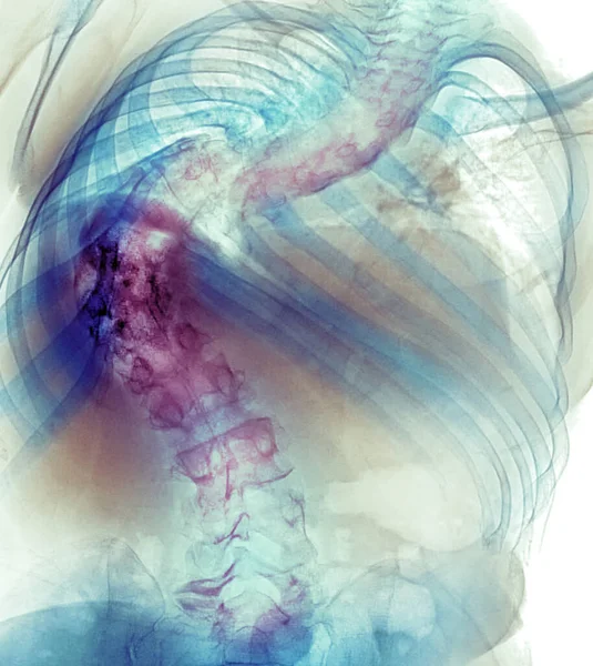 背痛表现严重脊柱侧弯的病人脊柱彩色X线片 脊柱侧弯具有旋转成分的结构曲率 — 图库照片