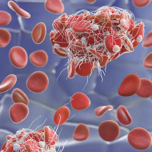stock image Illustration of red blood cells (erythrocytes) trapped in a fibrin mesh (white) forming a clot. The production of fibrin is triggered by cells called platelets, activated when a blood vessel is damaged. 