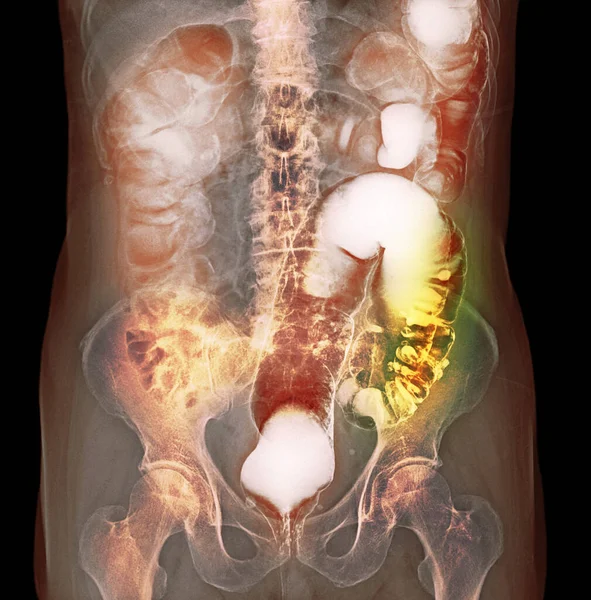 Coloured barium enema contrast X-ray showing colon diverticula. Diverticula are small bulging pouches that can form in the lining of the digestive tract, most often in the lower part of the large intestine or colon.
