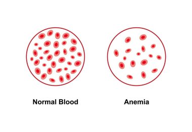 Scientific designing of Normal and anaemic blood, illustration. clipart