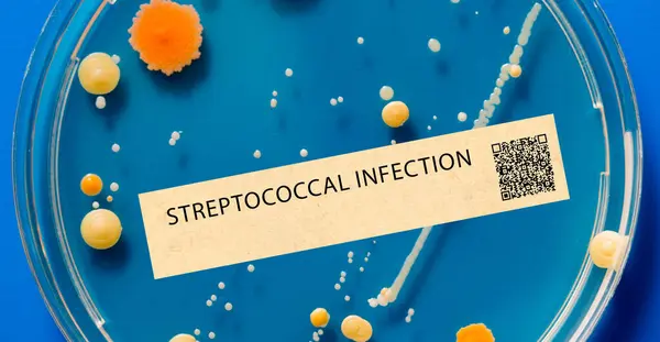 Zakażenie Paciorkowcem Jest Zakażenie Bakteryjne Które Może Powodować Paciorkowca Szkarlatynę — Zdjęcie stockowe