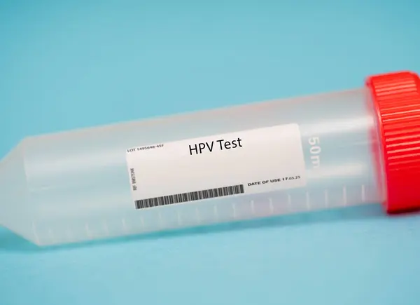 Teste Hpv Teste Hpv Teste Triagem Para Papilomavírus Humano Hpv — Fotografia de Stock