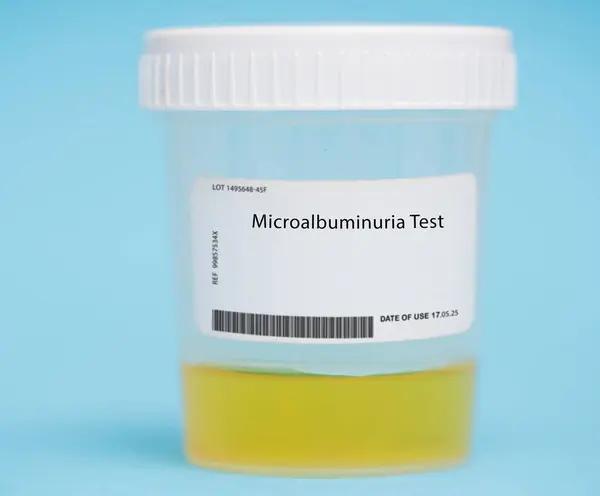 Microalbuminuria Test Test Measures Levels Albumin Protein Can Indicate Early — Stock Photo, Image