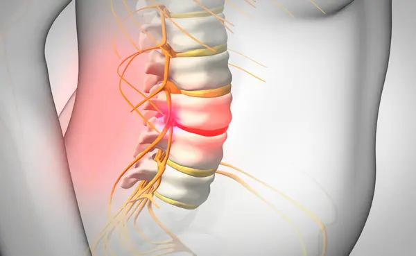 Hernia Discal Espinal Ilustración — Foto de Stock