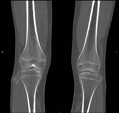 Sağlıklı dizlerin renkli bilgisayarlı tomografi (CT) taraması.