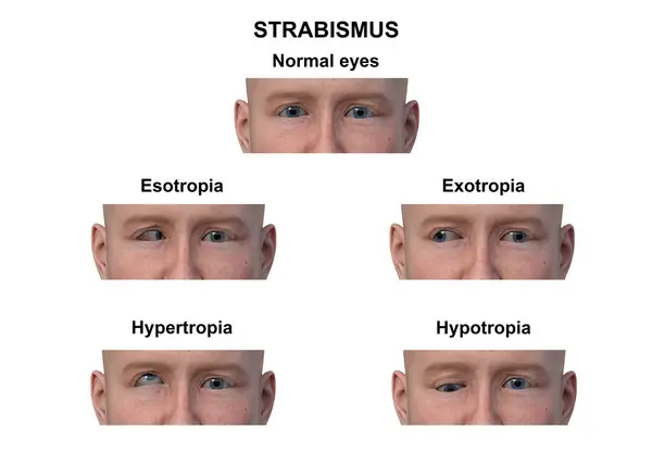 stock image Labelled illustration of a man with various strabismus types: esotropia, exotropia, hypertropia, and hypotropia.