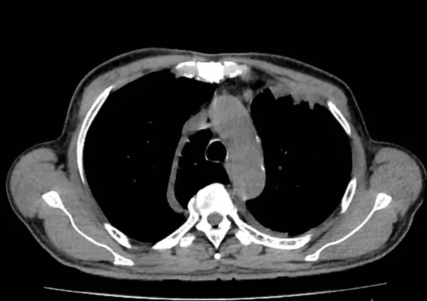 stock image Computed tomography (CT) scan of a chest from above showing an azygos lobe in the left lung (segmented area centre-left). An azygos lobe is an anatomical variant in the upper lobe of the lung in which a segment of the lung 