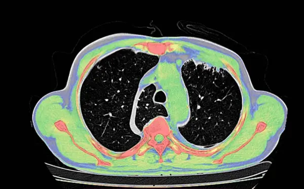 stock image Coloured computed tomography (CT) scan of a chest from above showing an azygos lobe in the left lung (segmented area centre-left). 