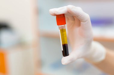 Laboratory analyzing technology. Blood sample in tube close up.