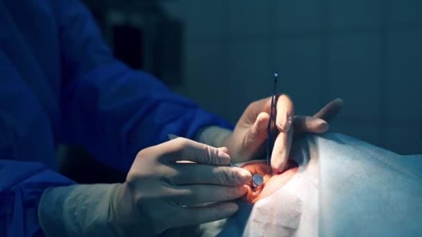 Sebész Operálja Beteget Szemműtétet Végző Sebész — Stock videók