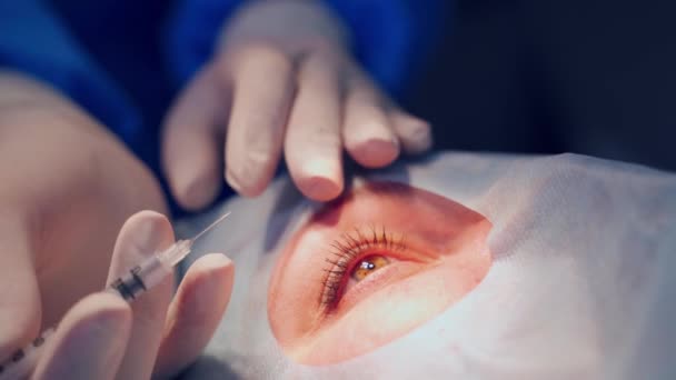 滅菌カバーの下で患者 目の手術の詳細を閉じる — ストック動画