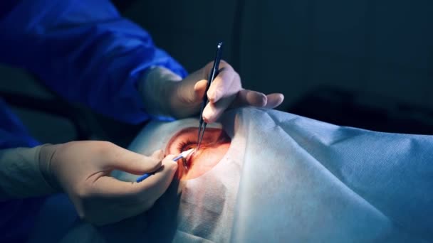 Zbliż Szczegóły Operacji Oczu Ręce Chirurga Rękawiczkach Wykonujących Laserową Korekcję — Wideo stockowe