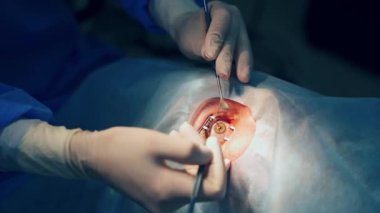Katarakt ameliyatı yakın çekim. Hastane ameliyatında cerrah göz kataraktı
