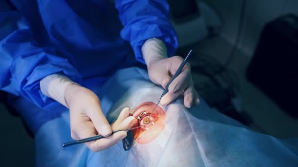 Szemészeti Műtét Szemnek Szemészeti Műtét Során Műtőben Lévő Beteg — Stock videók